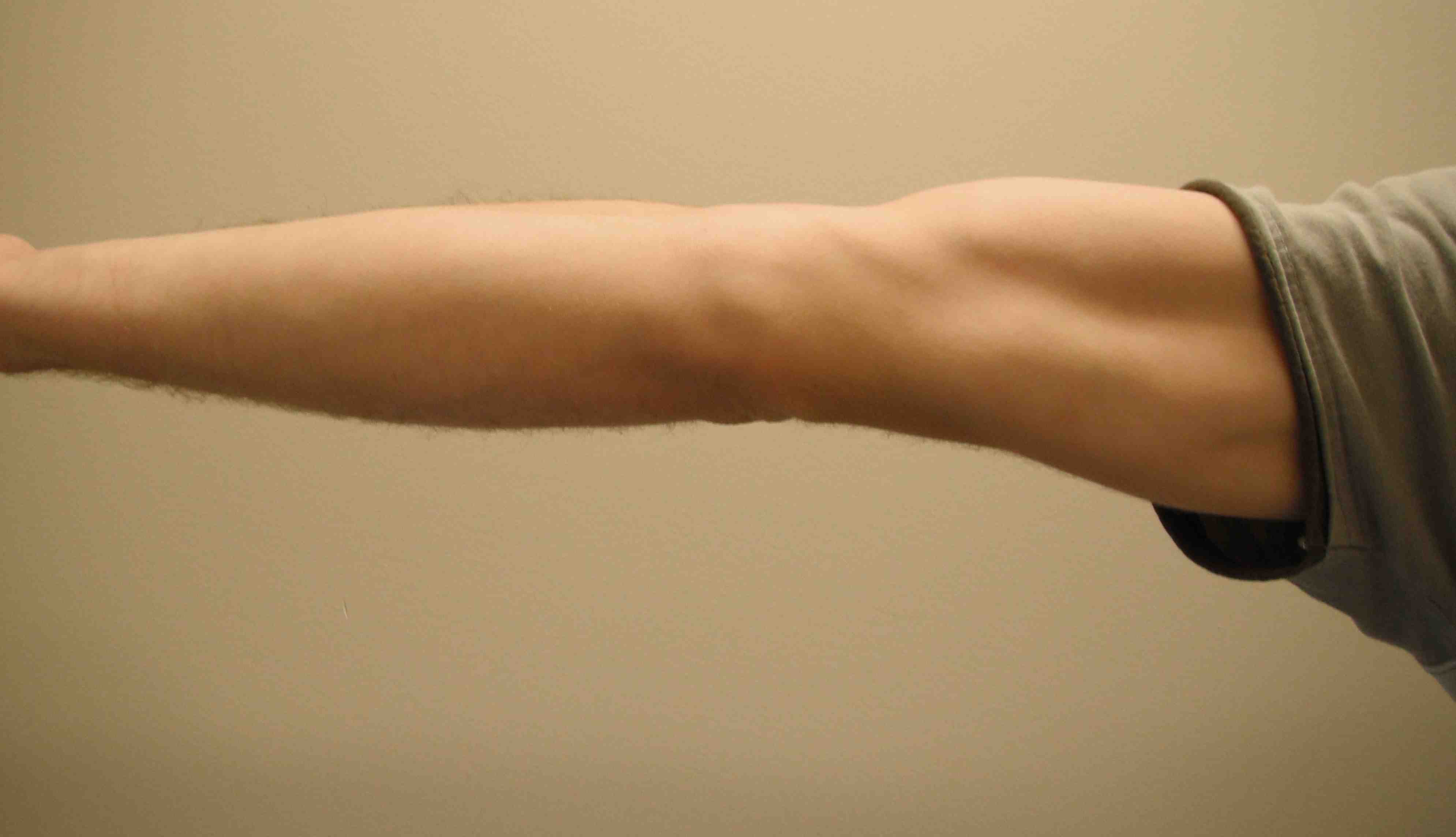 Ligamentous Laxity Elbow Hyperextension